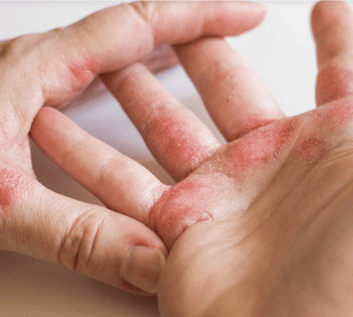 Eczema