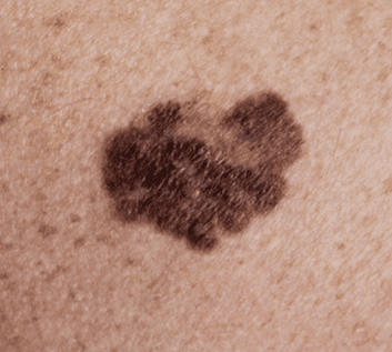 Melanoma & Other Skin Cancers