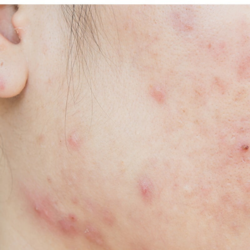 Acne & Rosacea