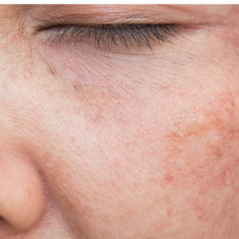 Light Related Skin Disease and Pigmentation Disorders