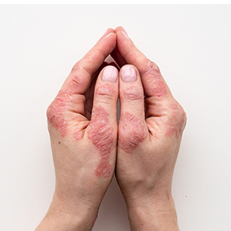 Psoriasis and Other Papulosquamous Disease